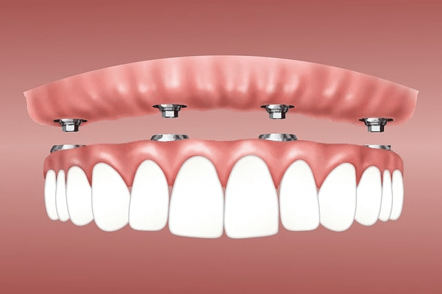 teeth implants