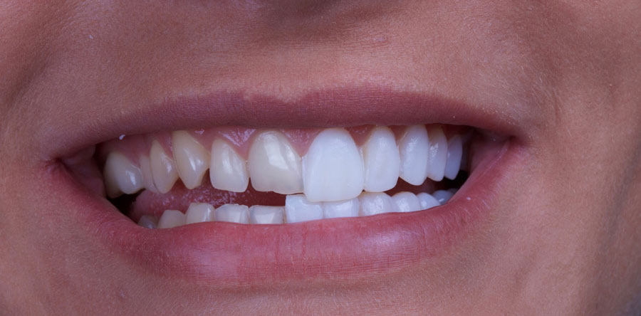 teeth veneers